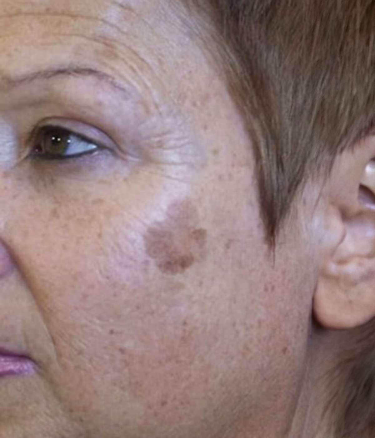 CryoPewn-Revitalife Clinic
